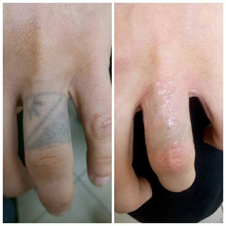 Détatouage au laser