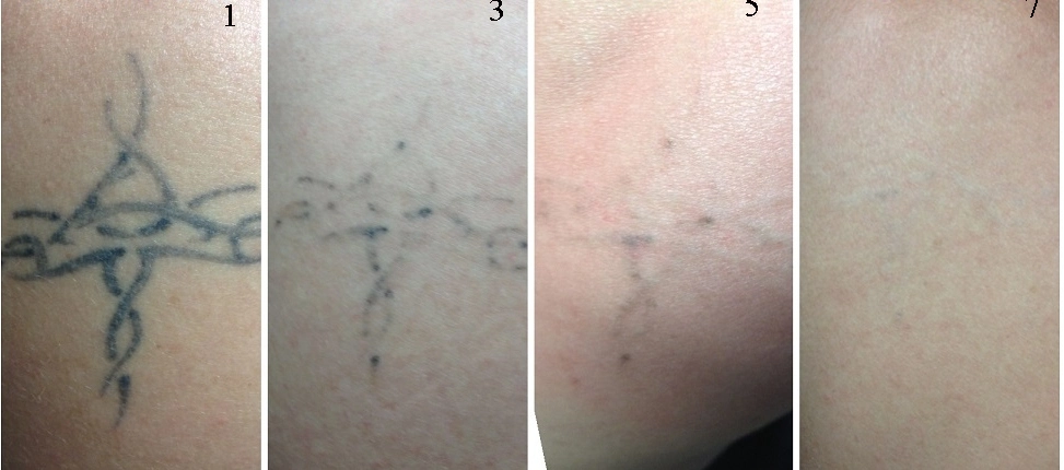 Détatouage au laser