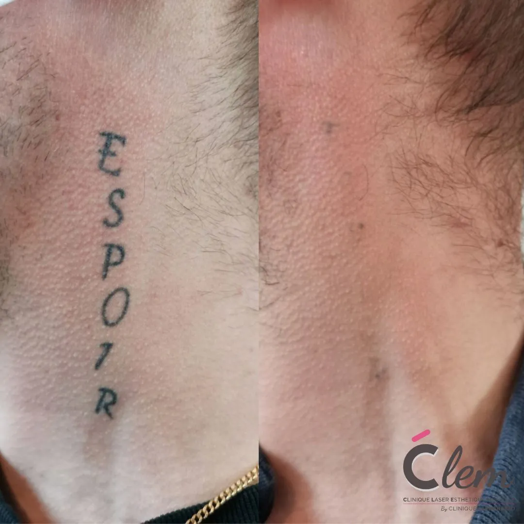 Détatouage au laser