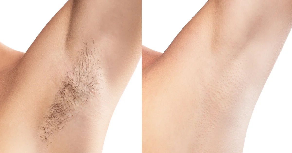 Epilation aisselle - EPILIA