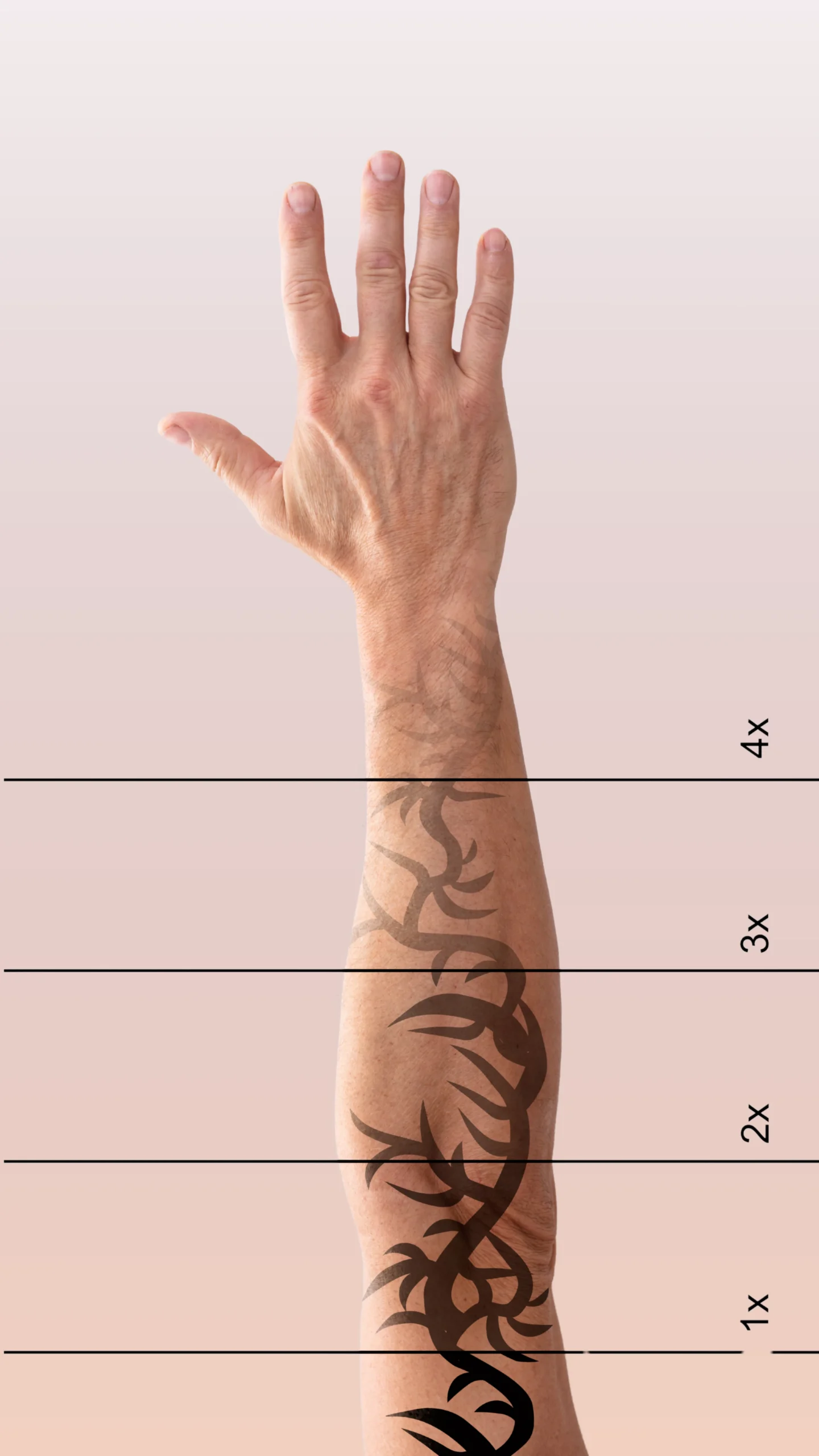 Détatouage au laser