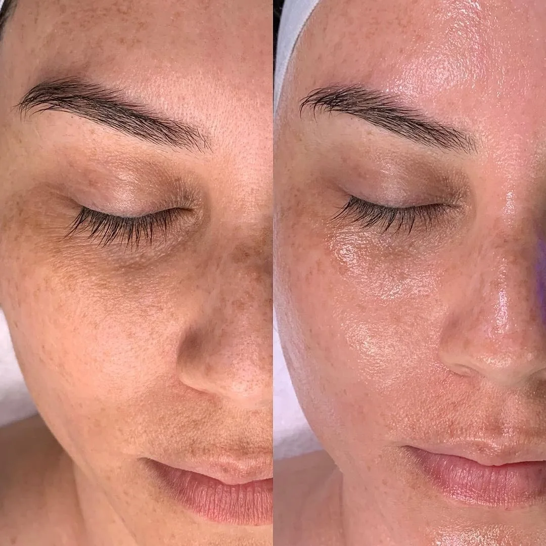 Hydrafacial Alger - EPILIA