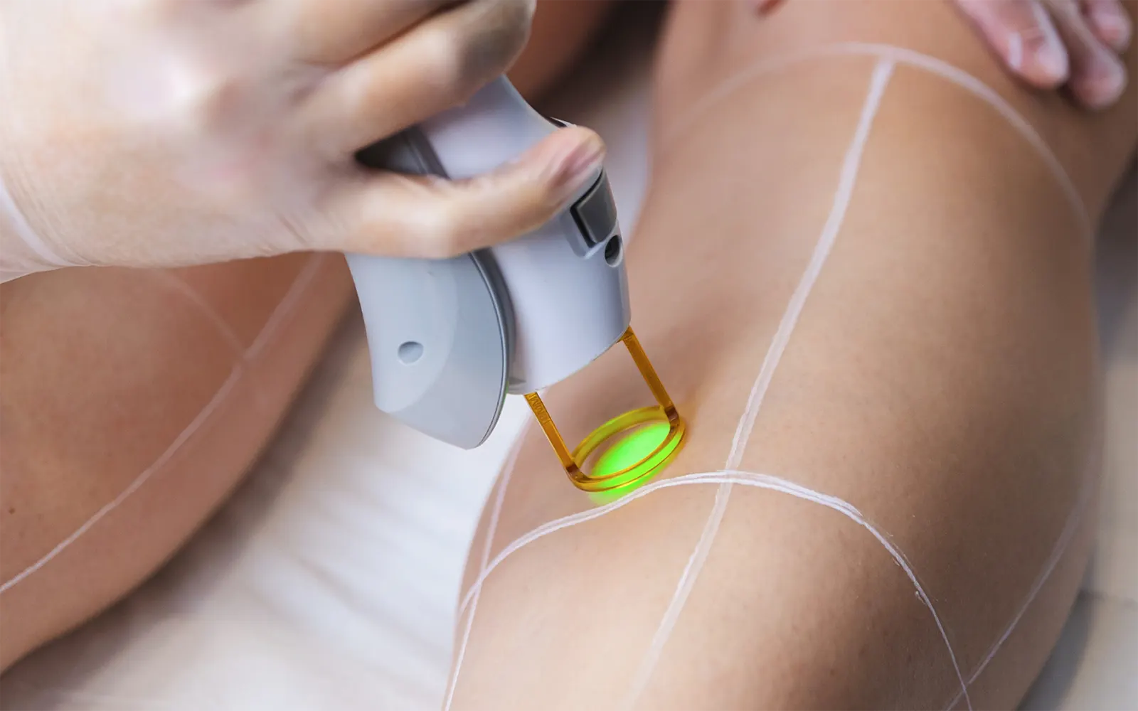 Epilation laser - EPILIA