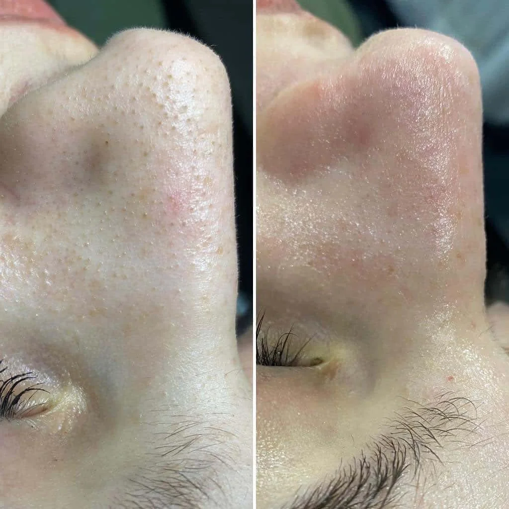 Hydrafacial Alger - EPILIA
