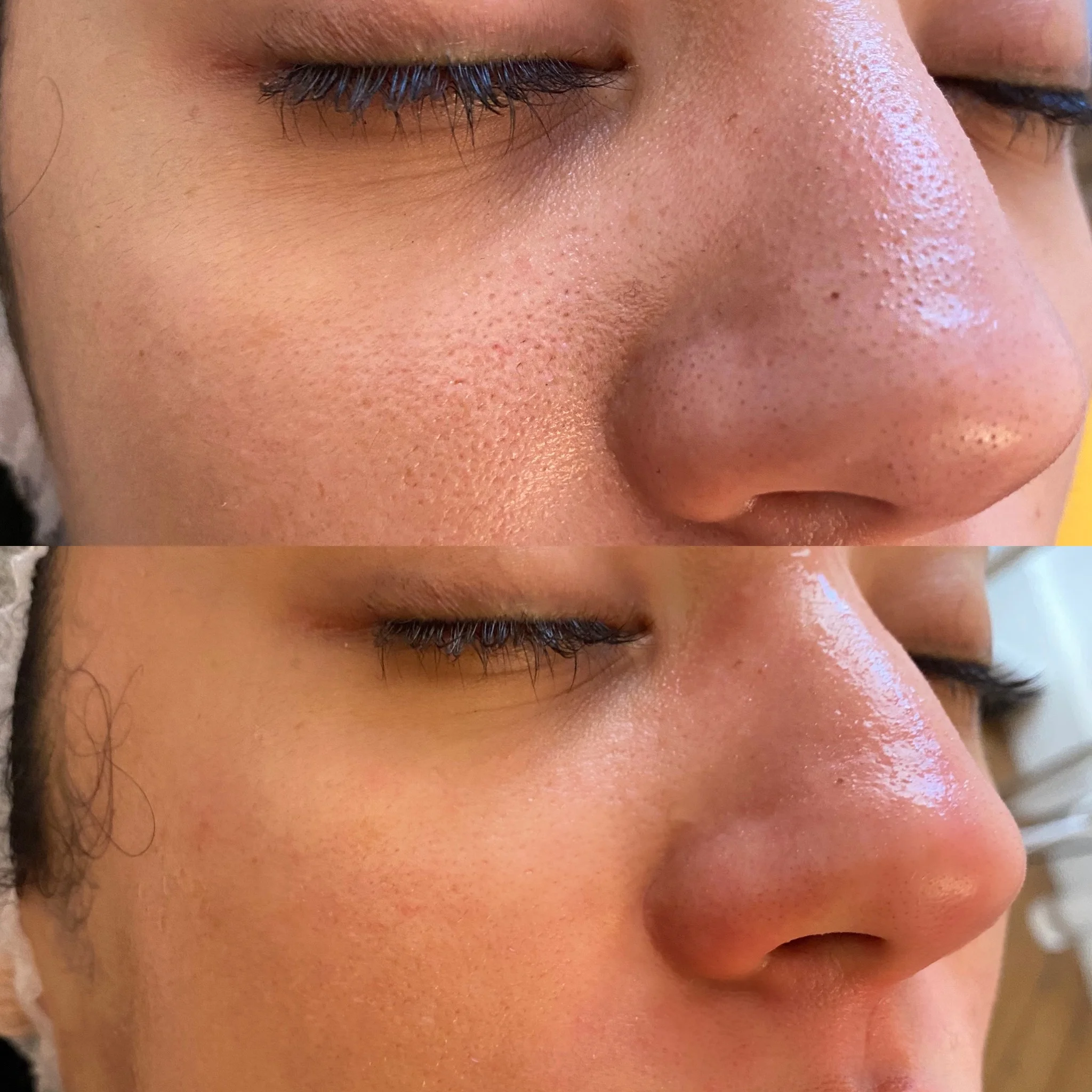 Hydrafacial Alger - EPILIA
