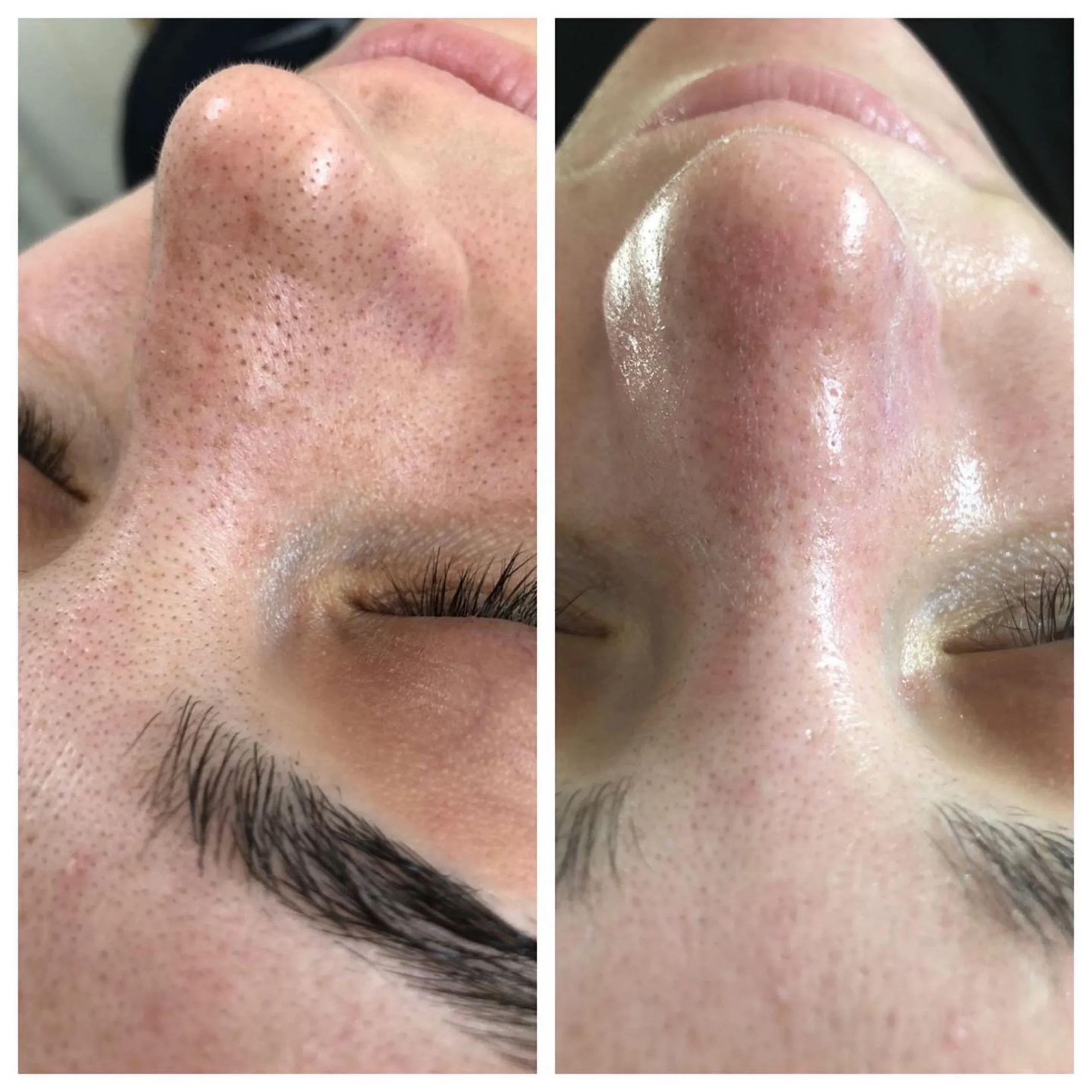 Hydrafacial Alger - EPILIA