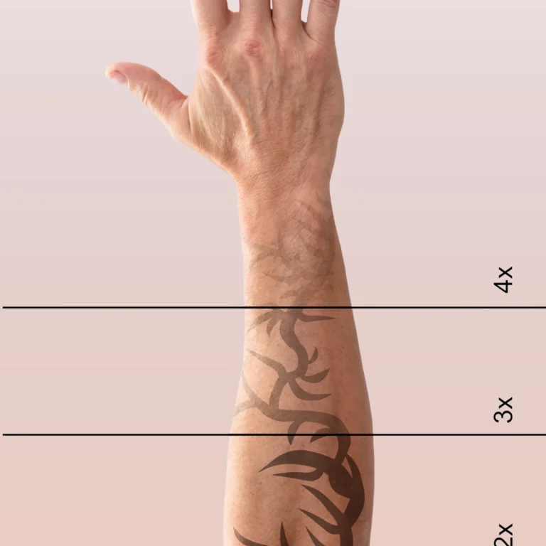 Détatouage au laser